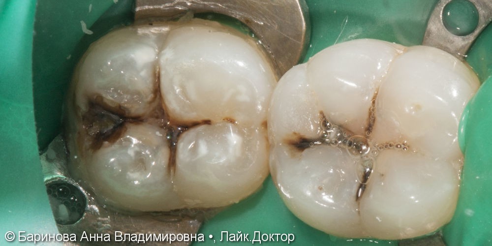 Лечение глубокого кариеса 4.7 и 4.6 зубов - фото №1