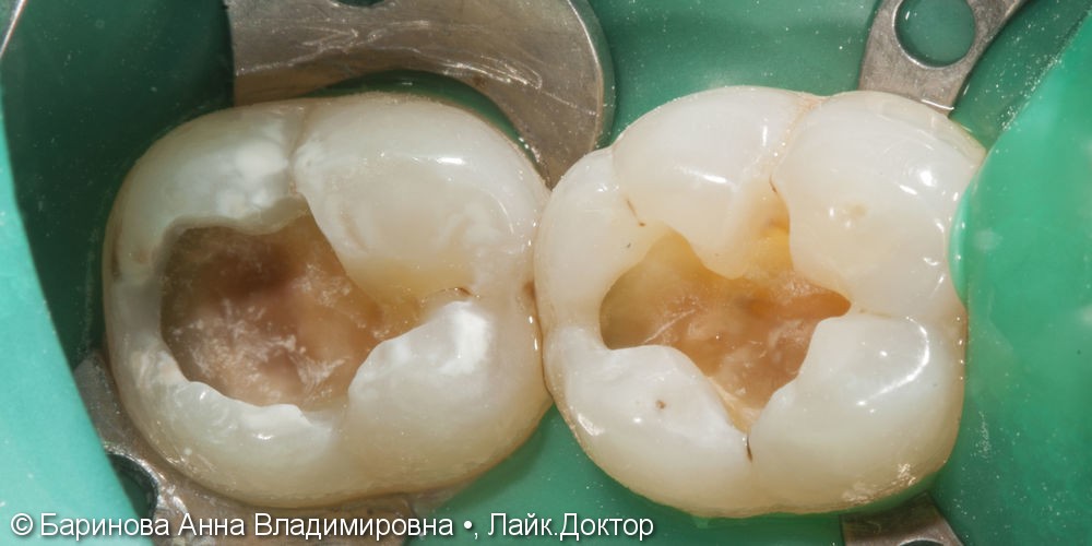 Лечение глубокого кариеса 4.7 и 4.6 зубов - после
