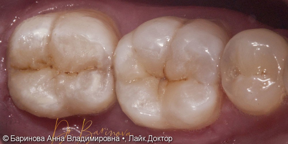 Лечение глубокого кариеса 4.7 и 4.6 зубов - фото №3