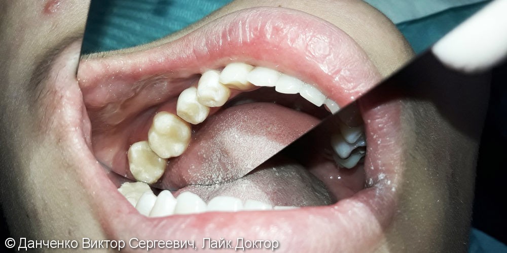 Реставрация 3-х зубов фотополимером Ceram-Х - фото №3