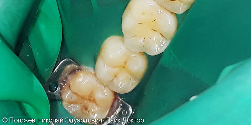 Лечение и реставрация зуба - фото №1