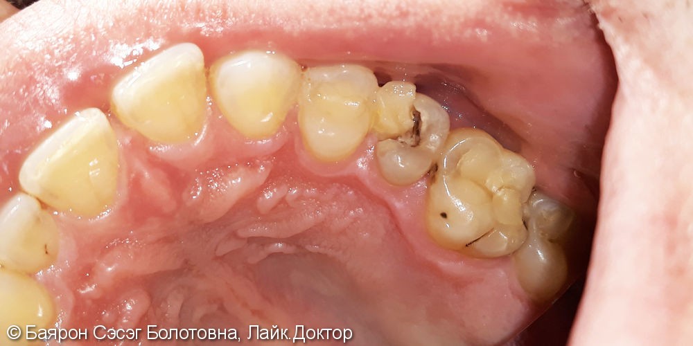 Лечение фиссурного кариеса зубов с №14 по №17 с использованием фотополимера Filtek - фото №1