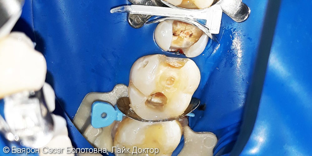 Лечение фиссурного кариеса зубов с №14 по №17 с использованием фотополимера Filtek - фото №2