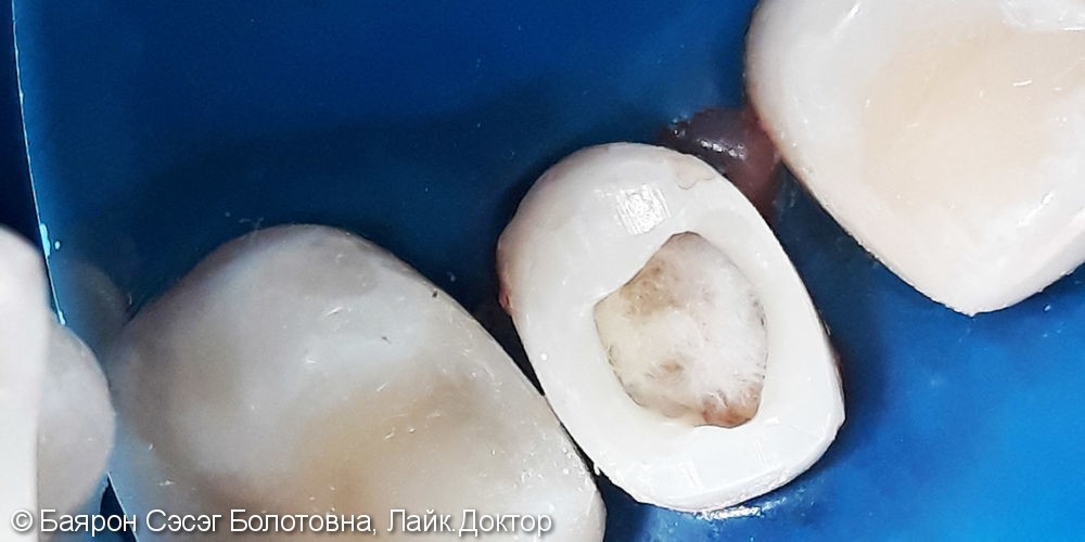 Лечение фиссурного кариеса зубов с №14 по №17 с использованием фотополимера Filtek - фото №3