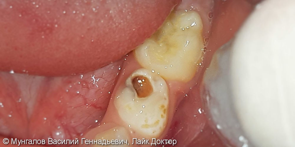 Лечение и реставрация зуба №74 фотополимером Filtek - фото №1