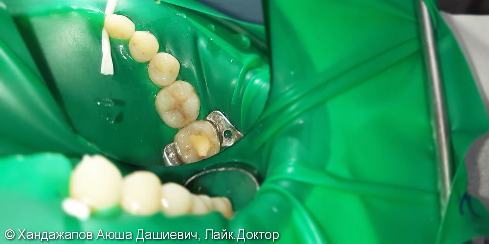 Лечение и реставрация Четырех зубов фотополимером Ceram-X - фото №1