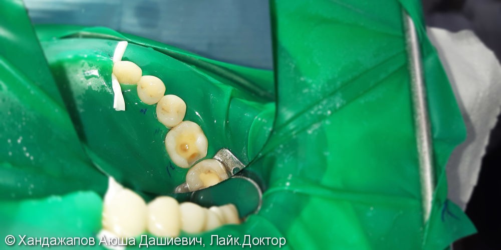 Лечение и реставрация Четырех зубов фотополимером Ceram-X - фото №2