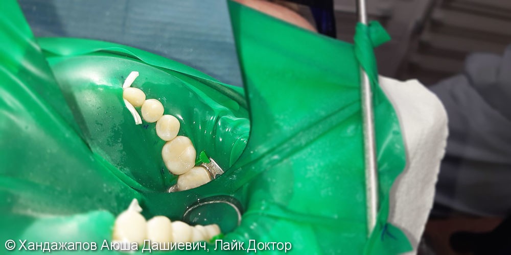 Лечение и реставрация Четырех зубов фотополимером Ceram-X - фото №3