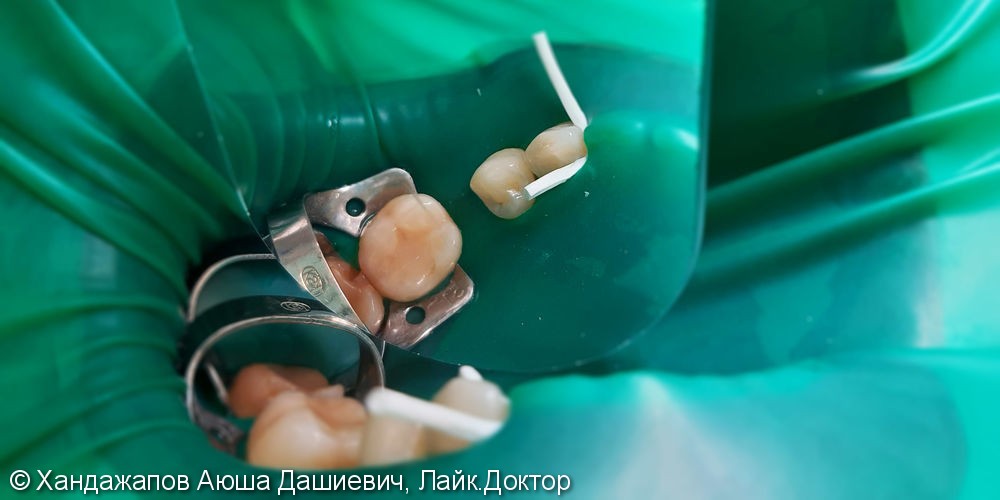 Лечение и реставрация зубов №44/№46 фотополимером Ceram-X - фото №1