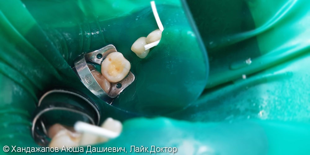 Лечение и реставрация зубов №44/№46 фотополимером Ceram-X - фото №2