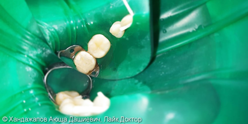 Лечение и реставрация зубов №44/№46 фотополимером Ceram-X - фото №3