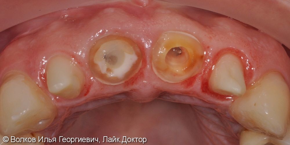 Естественный природоподобный результат: импланты нобель, керамика Emax - фото №1