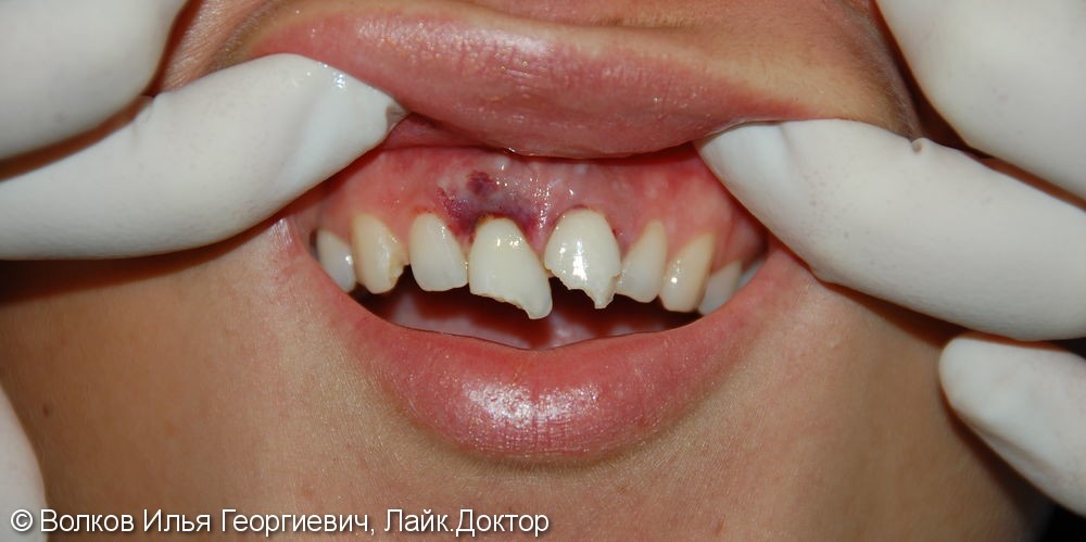 Реабилитация во фронтальном отделе зубов верхней челюсти с применением имплантатов Нобель - фото №1