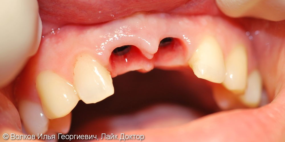 Реабилитация во фронтальном отделе зубов верхней челюсти с применением имплантатов Нобель - фото №2