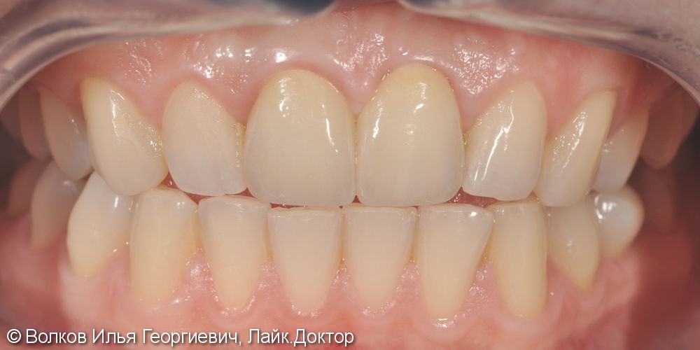 Реабилитация во фронтальном отделе зубов верхней челюсти с применением имплантатов Нобель - фото №3