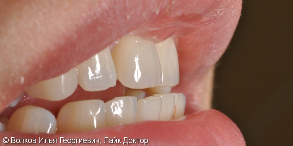 Реабилитация во фронтальном отделе зубов верхней челюсти с применением имплантатов Нобель - фото №4