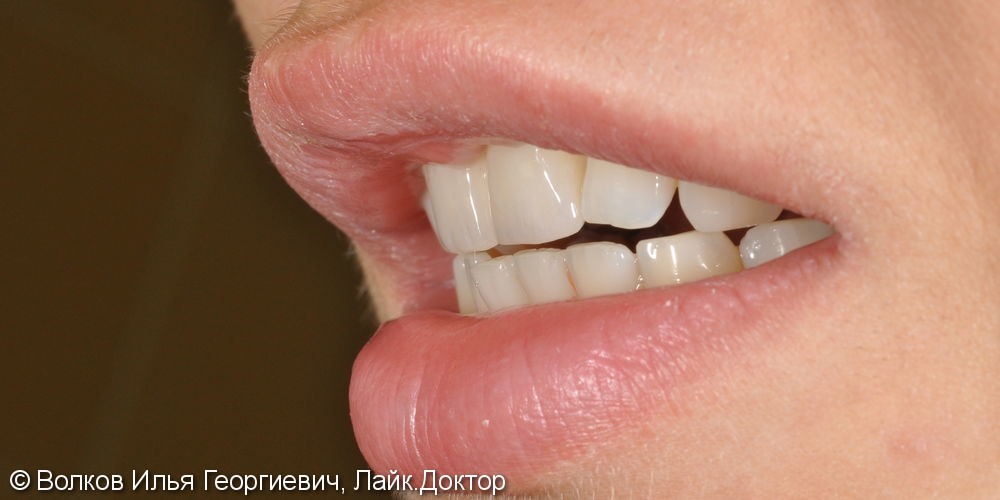 Реабилитация во фронтальном отделе зубов верхней челюсти с применением имплантатов Нобель - фото №5