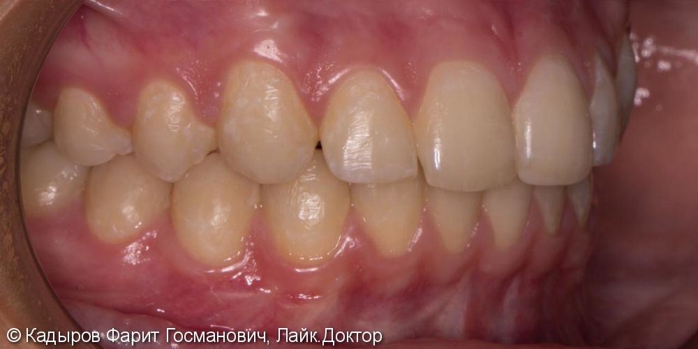 Исправление прикуса и выравнивание зубов - фото №6