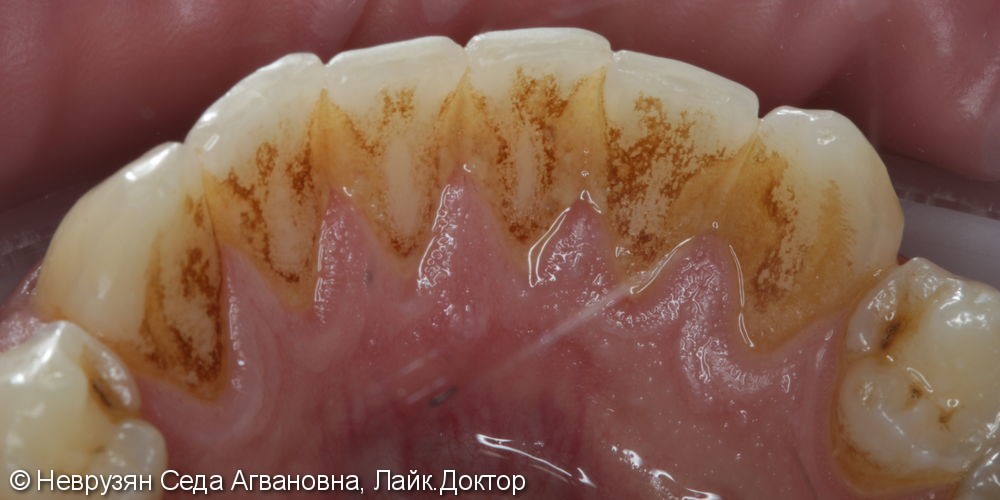 Профессиональная гигиена против коричневого налета на зубах - фото №2