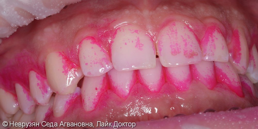 Профессиональная гигиена против коричневого налета на зубах - фото №3