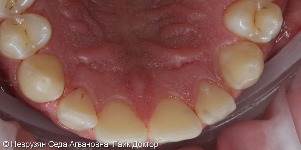 Профессиональная гигиена против коричневого налета на зубах - фото №5