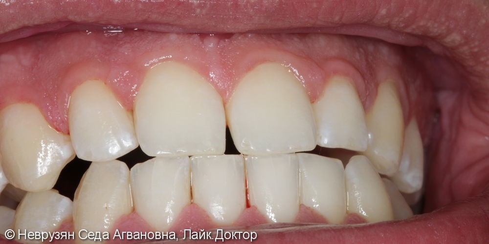 Профессиональная гигиена против коричневого налета на зубах - фото №6