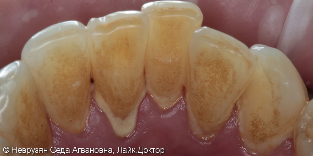 Профессиональная гигиена против коричневого налета на зубах - фото №1