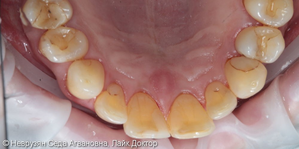 Профессиональная гигиена против коричневого налета на зубах - фото №4
