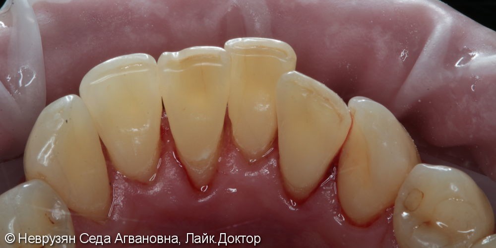 Профессиональная гигиена против коричневого налета на зубах - фото №5