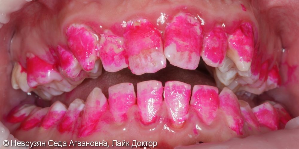 Профессиональная гигиена против коричневого налёта на зубах - фото №2