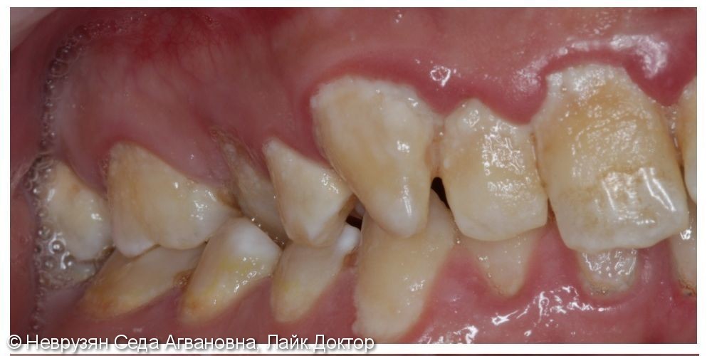 Профессиональная гигиена против коричневого налёта на зубах - фото №3