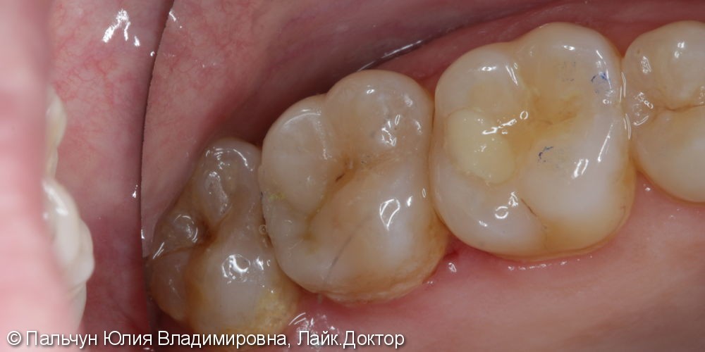 Лечение кариеса жевательного зуба - фото №4