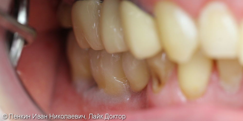 Коронки на винтовой фиксации на жевательные зубы - фото №8