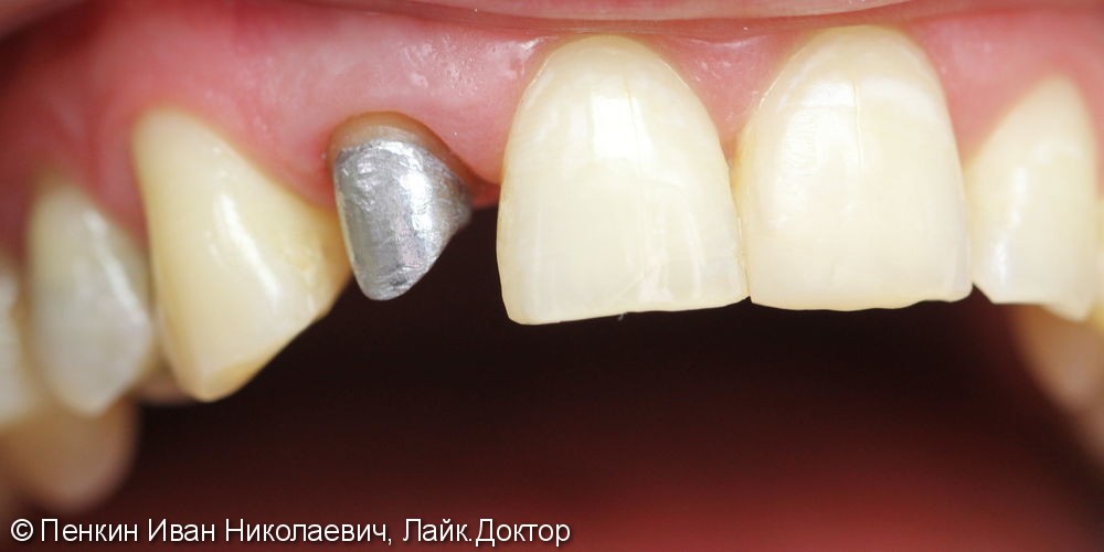 изготовлена коронка за Диоксида циркония на зуб 1.2, максимально эстетично - фото №1