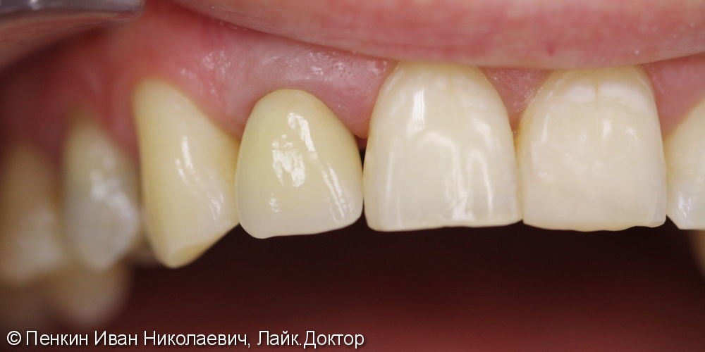 изготовлена коронка за Диоксида циркония на зуб 1.2, максимально эстетично - фото №2