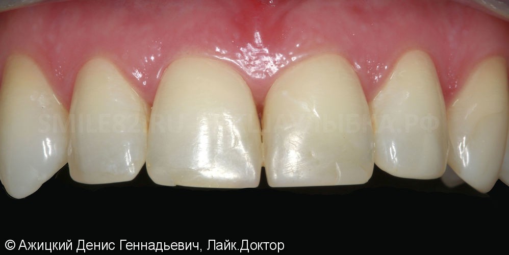 Реставрация передних зубов винирами! - фото №1