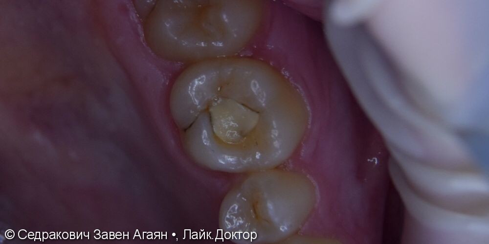 Лечения вторичного кариеса жевательного зуба 2.6 - фото №1