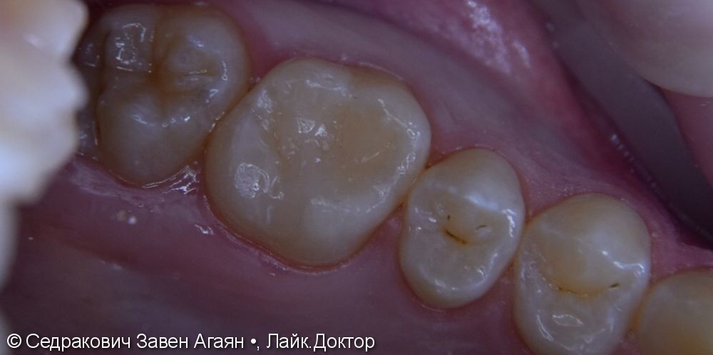 Лечения вторичного кариеса жевательного зуба 2.6 - фото №2
