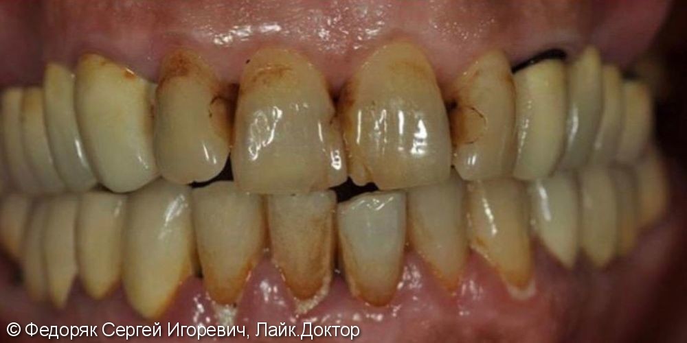 Эстетический дефект фронтальной группы зубов - фото №1