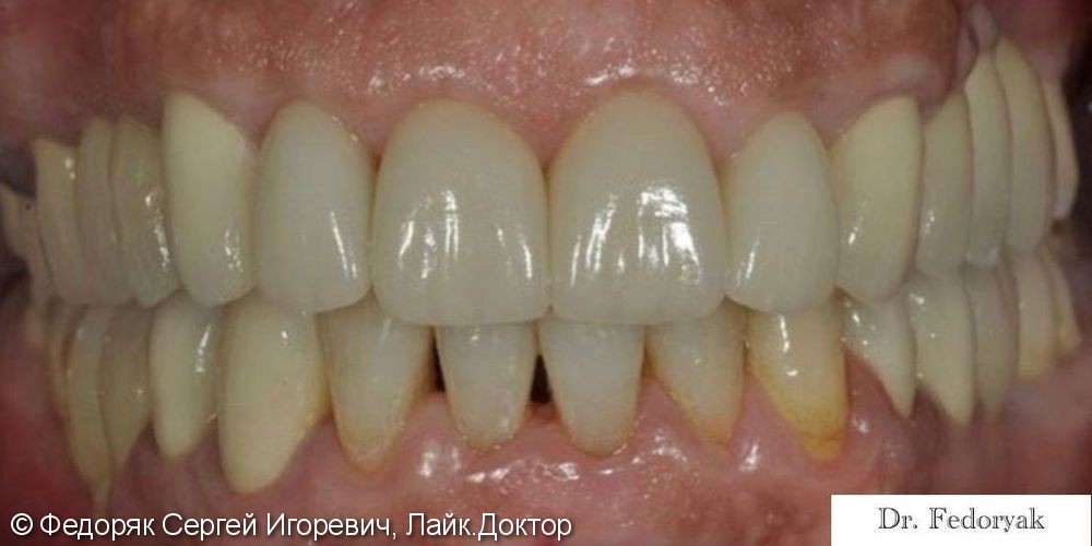 Эстетический дефект фронтальной группы зубов - фото №2