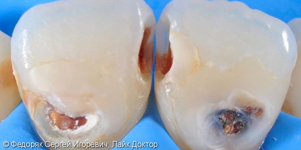 Лечение кариеса дентина 1.1 и 2.1 зубов - фото №1