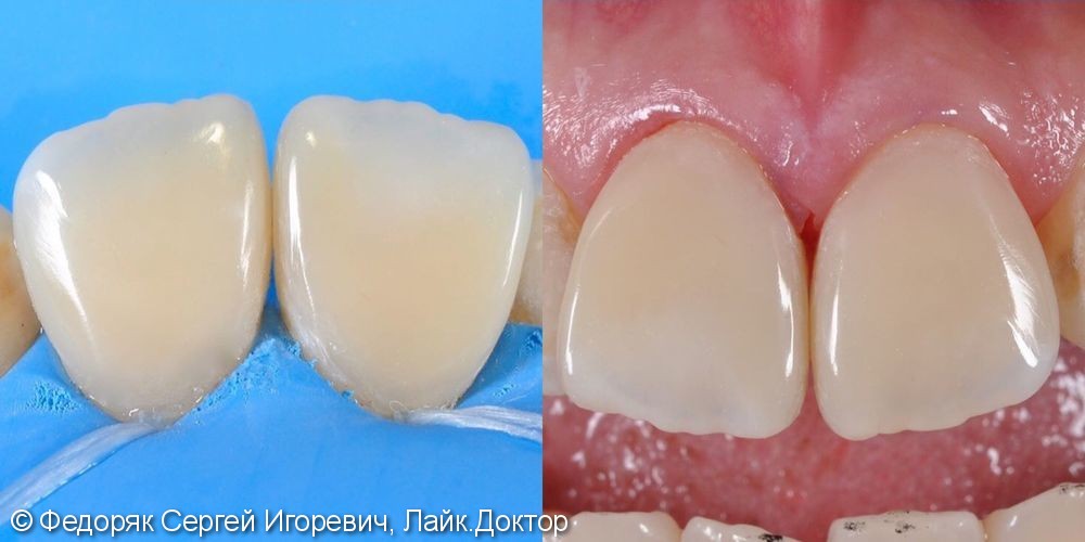 Лечение кариеса дентина 1.1 и 2.1 зубов - фото №2