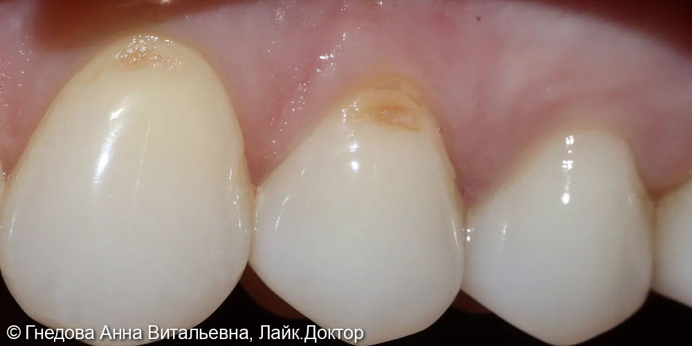 Лечение кариеса дентина зубов 2.3 и 2.4 - фото №1