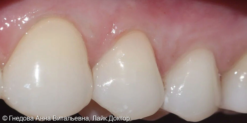 Лечение кариеса дентина зубов 2.3 и 2.4 - фото №2