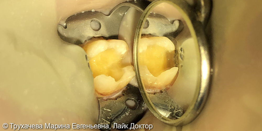 Лечение кариеса и реставрация зуба 3.6 - фото №1