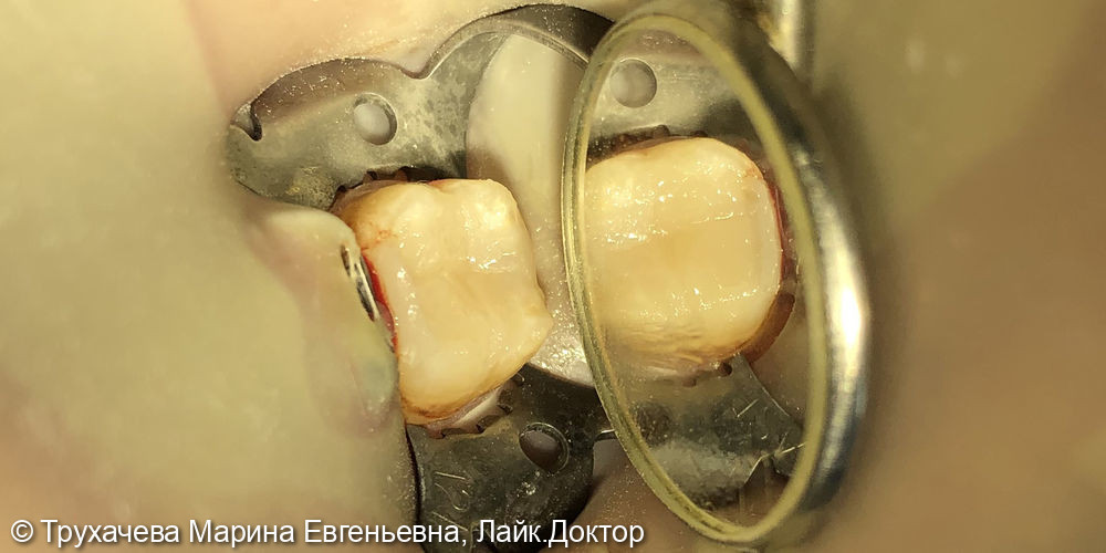 Лечение кариеса и реставрация зуба 3.6 - фото №2