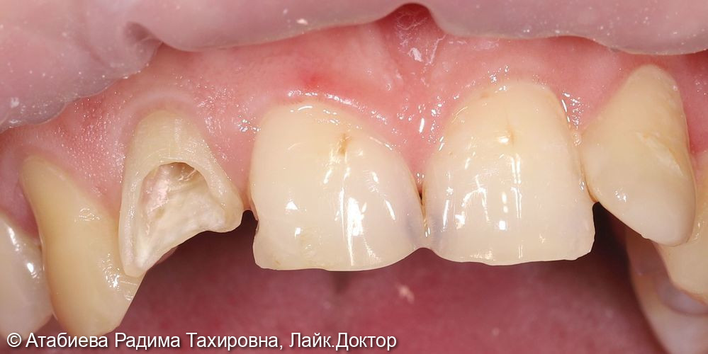 Восстановление зуба 1.2 на стекло-волоконном штифте - фото №1