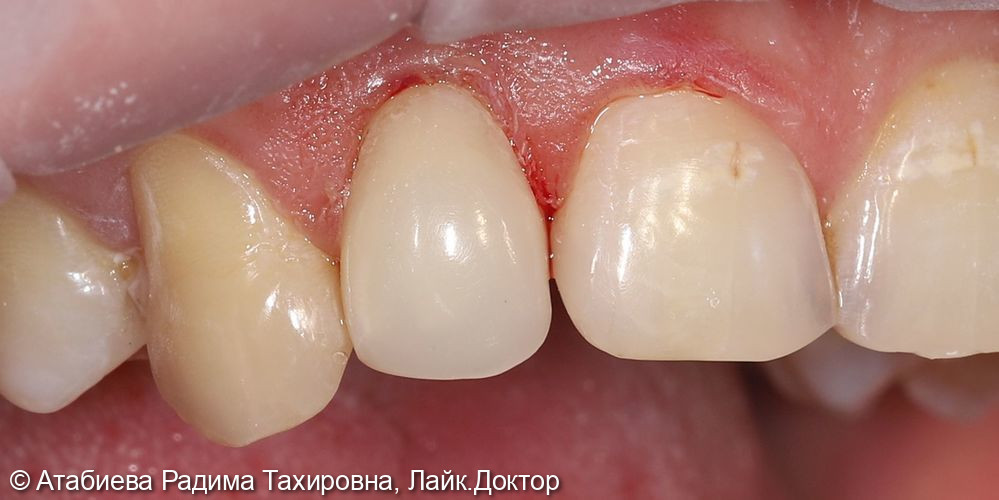 Восстановление зуба 1.2 на стекло-волоконном штифте - фото №2