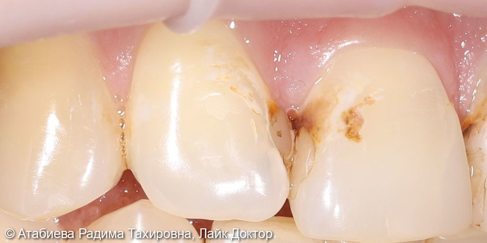 Лечение кариеса 11-12 зубов - фото №1