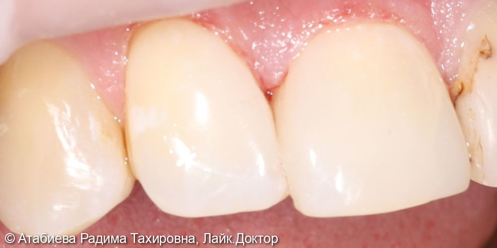 Лечение кариеса 11-12 зубов - фото №2